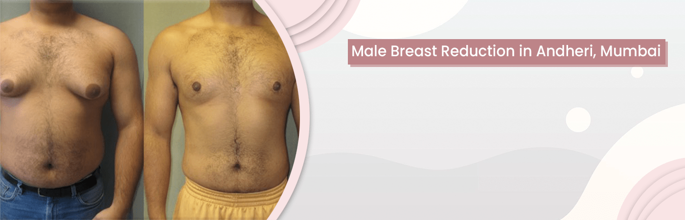 male breast reduction