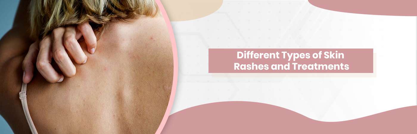 Different Types of Skin Rashes and Treatments