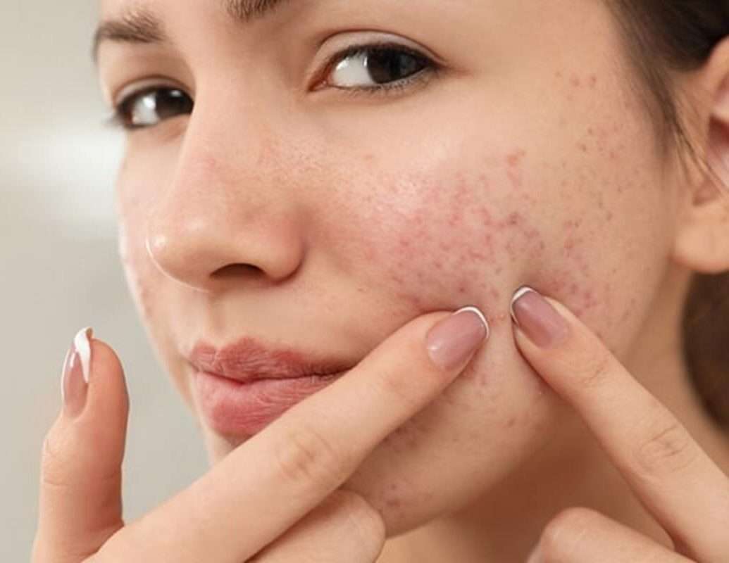 3 Dermatology Ingredients That Work Best For Reducing Scars - ReNue Rx