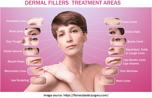 Dermal fillers treatment areas