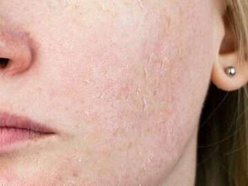 Winter Dry Skin: 11 Tips to Help Prevent Dry Skin