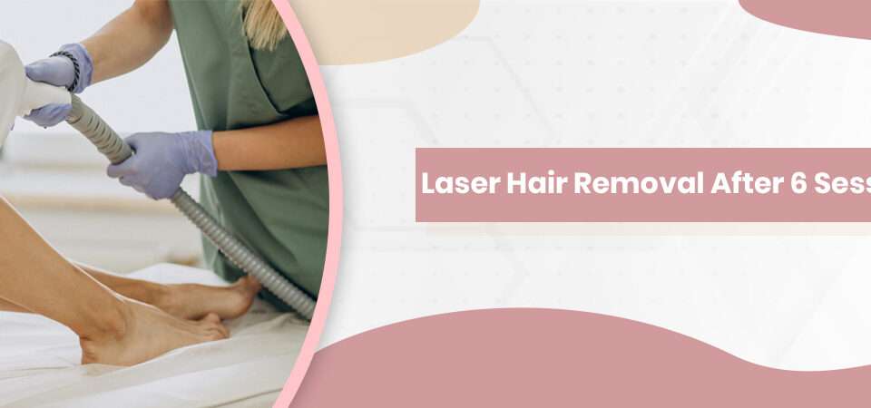 Laser Hair Removal After 6 Sessions