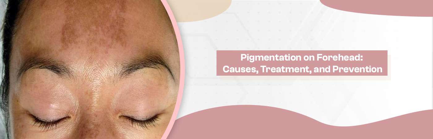 Pigmentation on Forehead: Causes, Treatment, and Prevention
