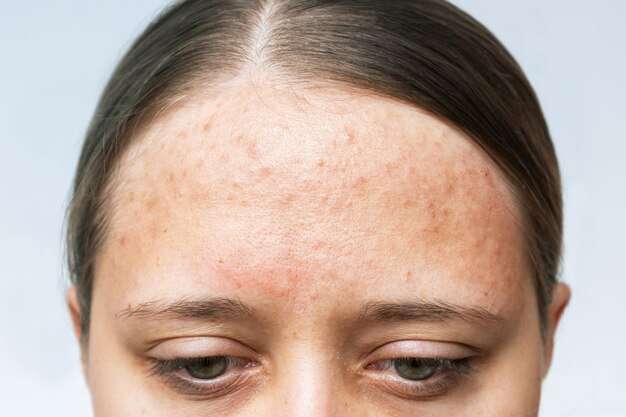 forehead pigmentation