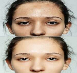 before and after procedure microneedling