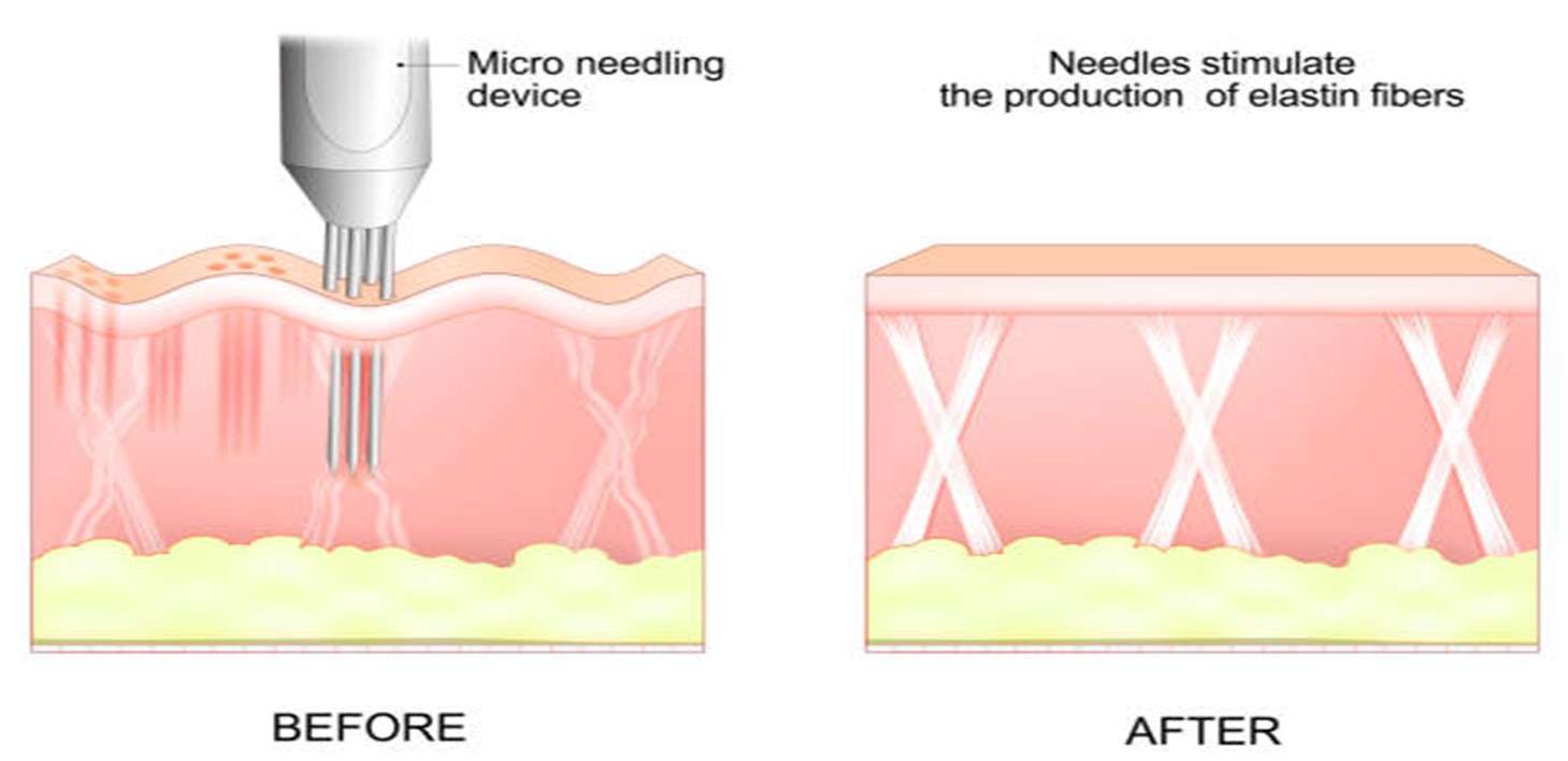 before & after microneedling procedure skin result