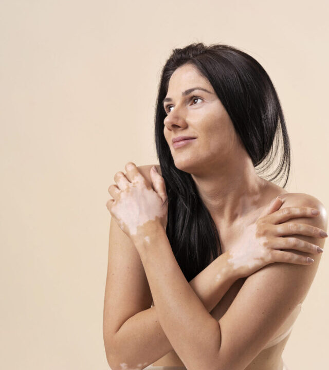 portrait-confident-woman-with-vitiligo