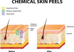 How do Chemical Peels Work on the Skin