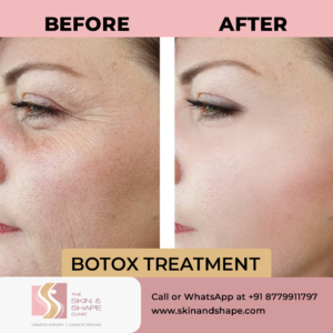 BOTOX TREATMENT