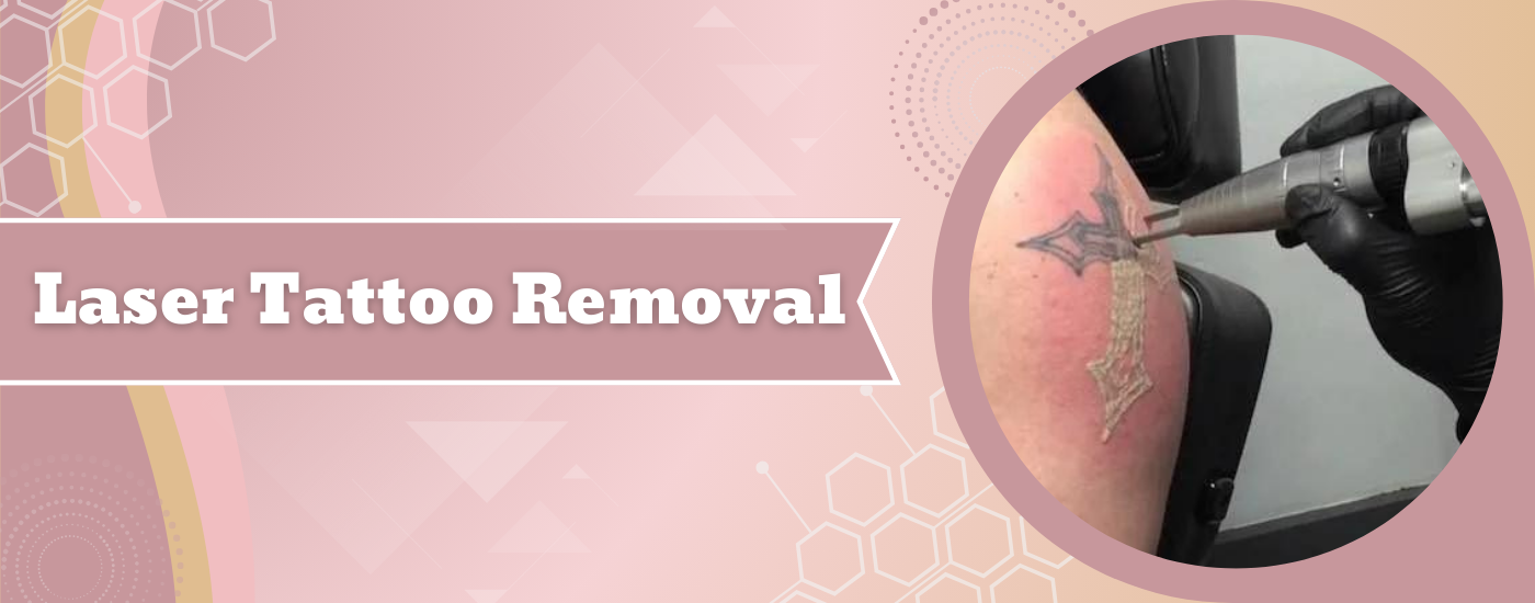 Laser Tattoo Removal in Mumbai