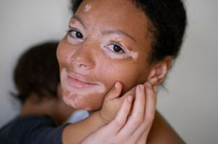 Overview of Vitiligo