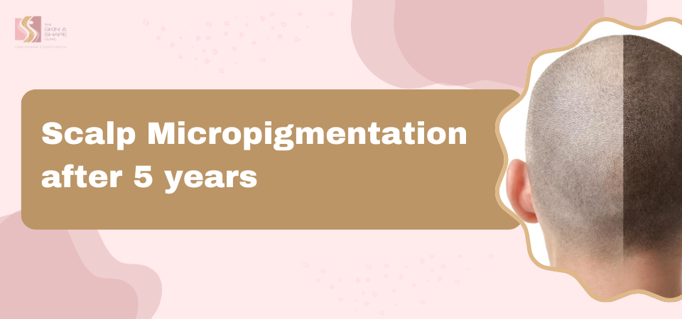 Scalp_Micropigmentation_after_5_years