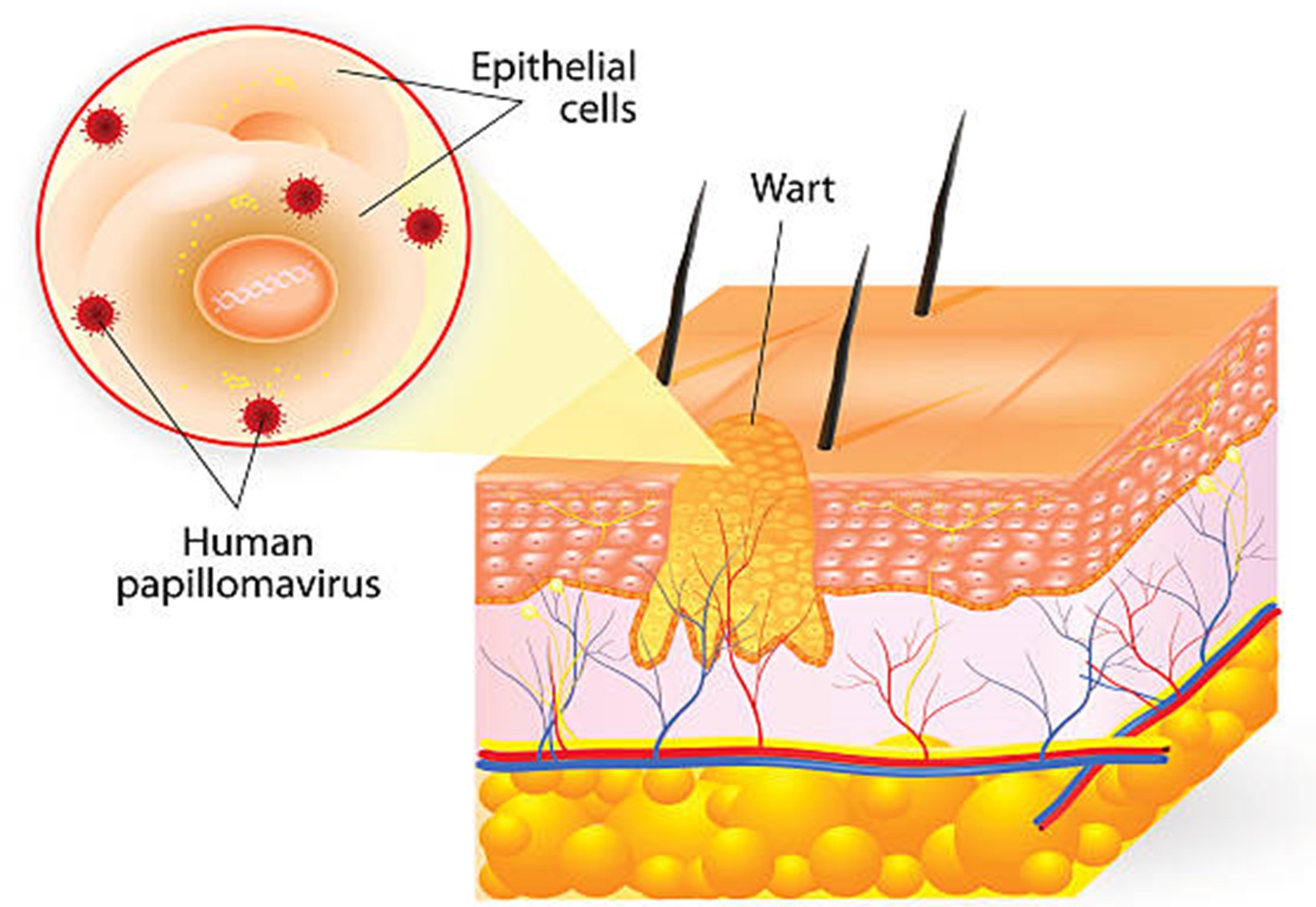 What Causes Warts?