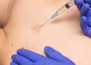 Corticosteroid Injections
