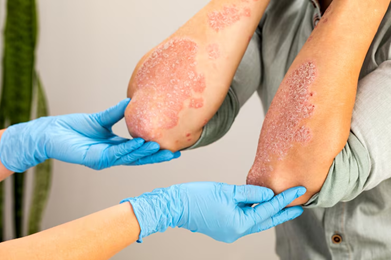 main cause of eczema