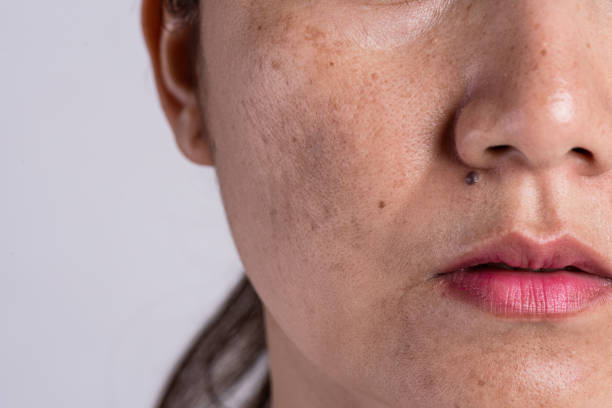 skin pigmentation disorders