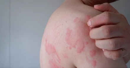 what triggers eczema