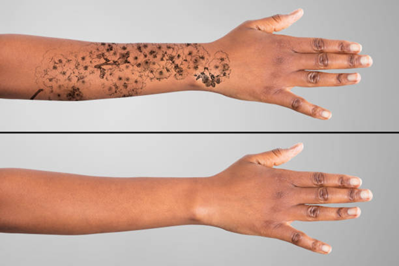 Laser Treatment for Tattoo Removal