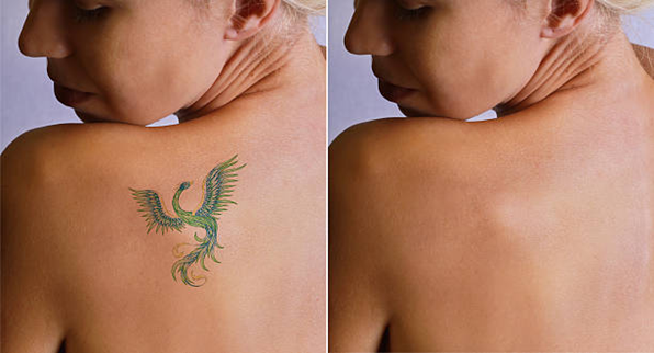 Laser Treatment for Tattoo Removal