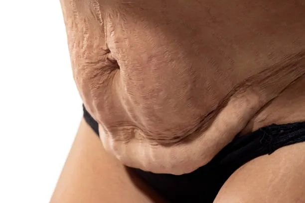Treatment for loose skin after weight loss