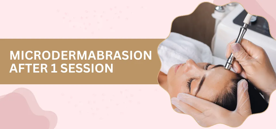 Microdermabrasion After 1 Session