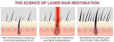 LLLT for Hair Restoration