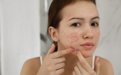 Acne_Scar_Removal_Treatment