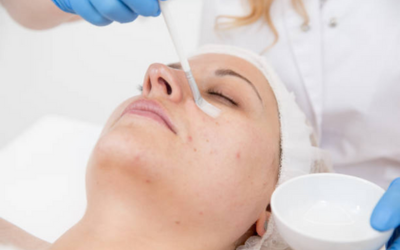Chemical_Peels