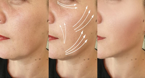 Endolift