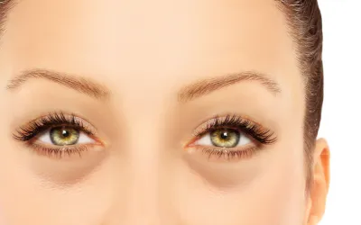 Lower_eyelid_laxity