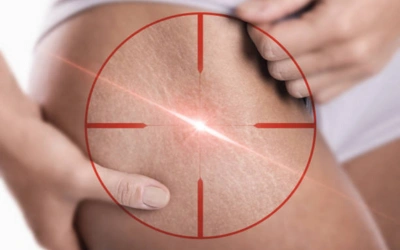 Laser Resurfacing _ Stretch Marks Laser Treatment