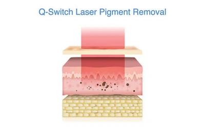 Laser Toning (Q-Switched Laser)