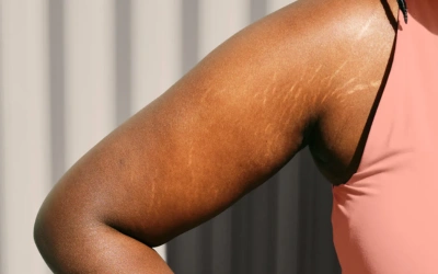 Puberty-Related Stretch Marks