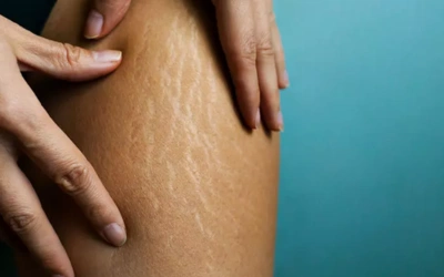 Striae Albae (White Stretch Marks)