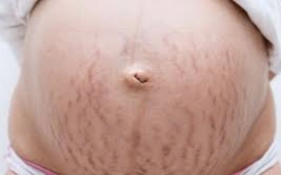 Striae Gravidarum