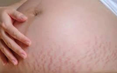 Striae Rubrae (Red Stretch Marks)