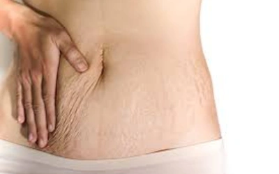 Weight-Change Stretch Marks