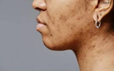 ●_Hormonal Changes