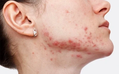 ●_Post-Inflammatory Hyperpigmentation