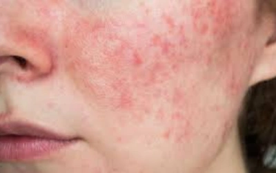 ●_Post-Injury or Inflammation