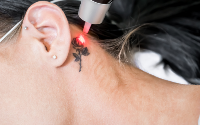 ●Tattoo-Removal