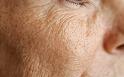 ●_Fine-Lines-and-Wrinkles