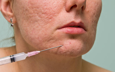 Acne Scar Treatment