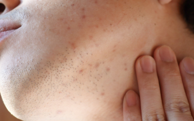 Acne Scarring