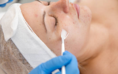 Chemical Peels