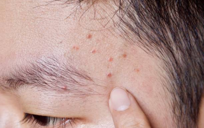 Comedonal Acne