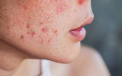 Inflammatory Acne