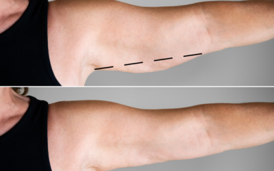 Targeted Arm Fat Reduction