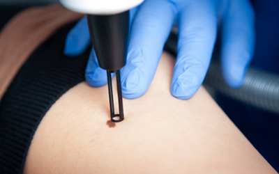 Close-up of a clinician wearing blue gloves using a precision instrument on a small brown skin lesion (mole) on a patient.