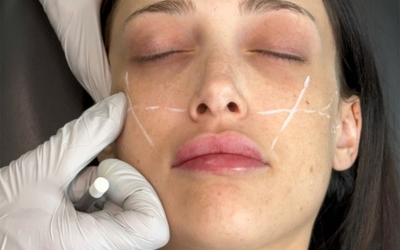 Close-up of a woman's face during a cosmetic procedure; white incision markings and X marks on cheeks and jawline, gloved hand holding a syringe near her cheek.